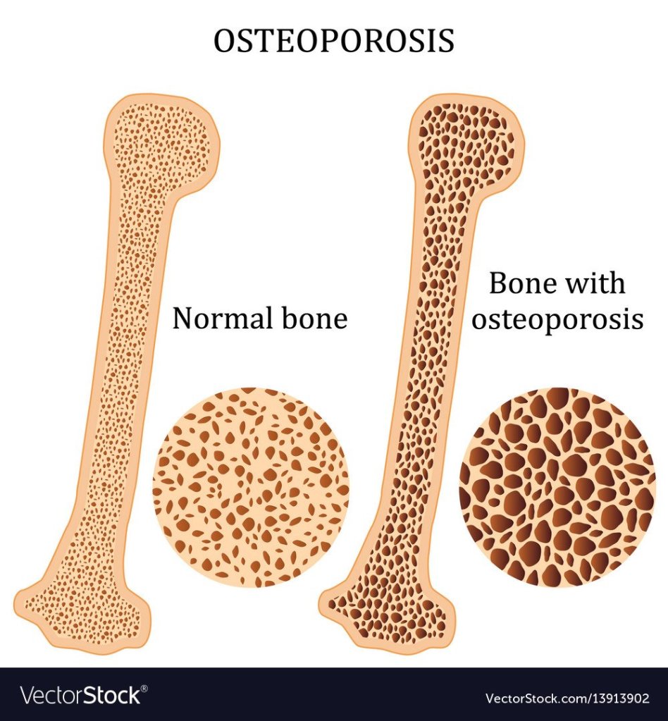The image shows the difference between healthy bones and bones with osteoporosis. 4 sure-fire ways to prevent osteoporosis.